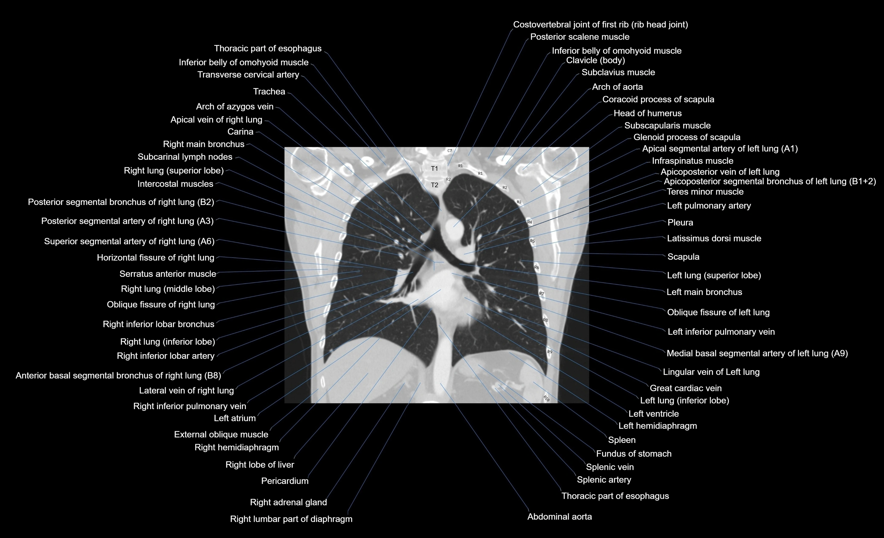 CT chest (thorax) lung window window labelled coronal cross sectional anatomy radiology image-00054.webp